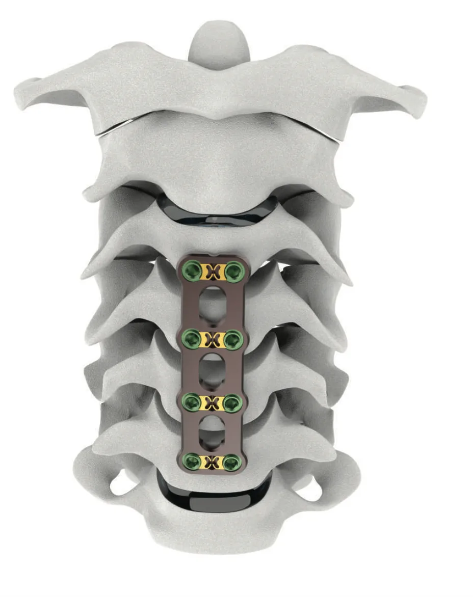 Regex Anterior Cervical Plate System