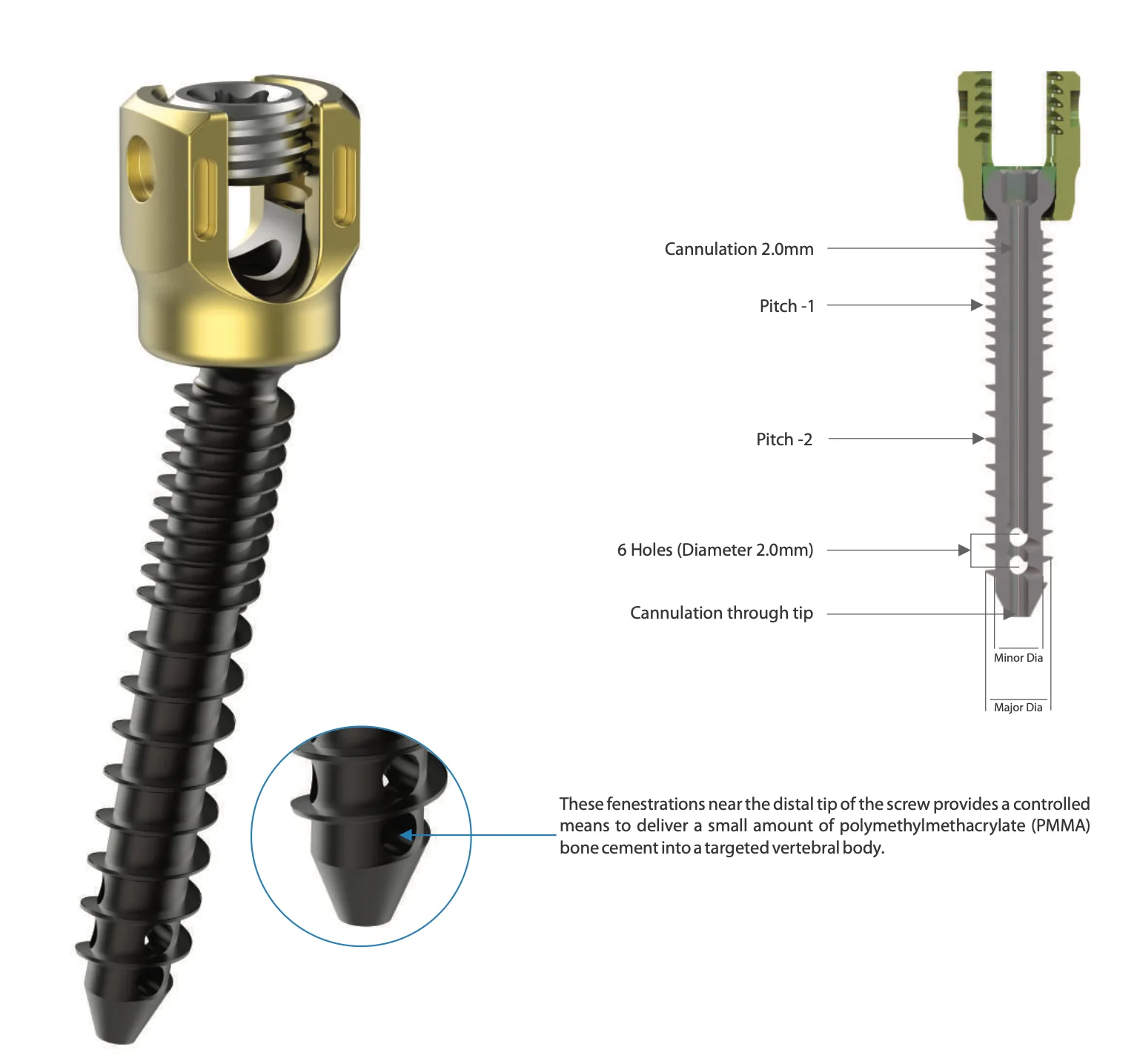 Osteobone Dual Thread Screw
