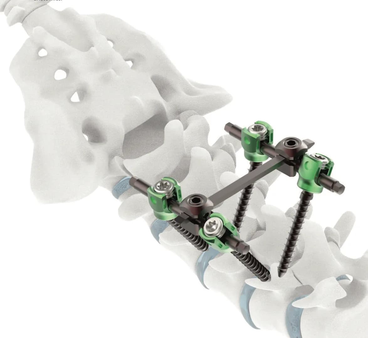 VERTAUX 5.5mm Pedicle Screw System