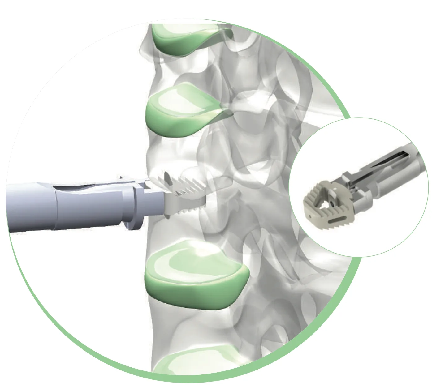 Knife Cervical Bladed Cage