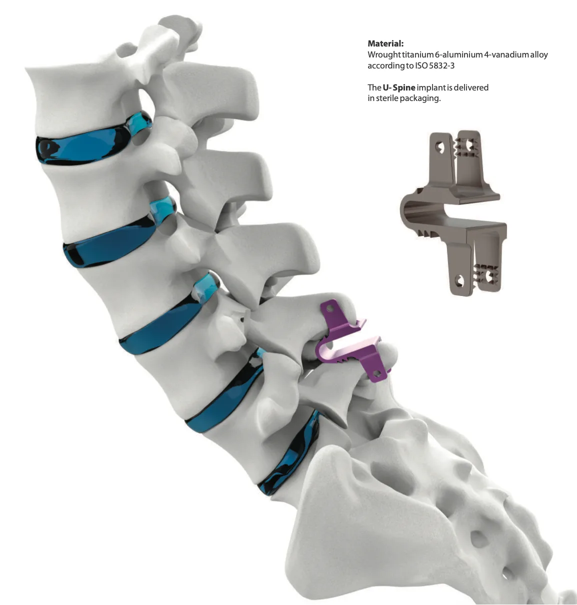 U-Spine System