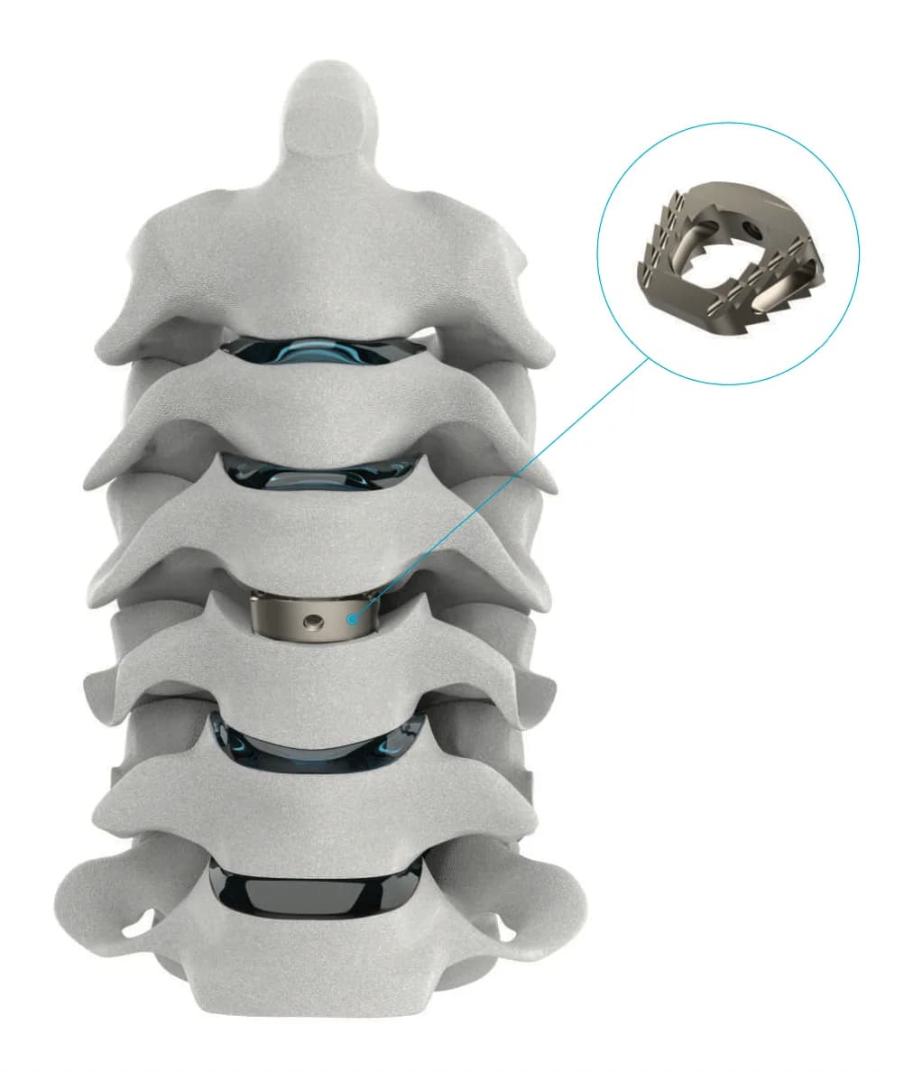 Cervical Cage (ACDF)