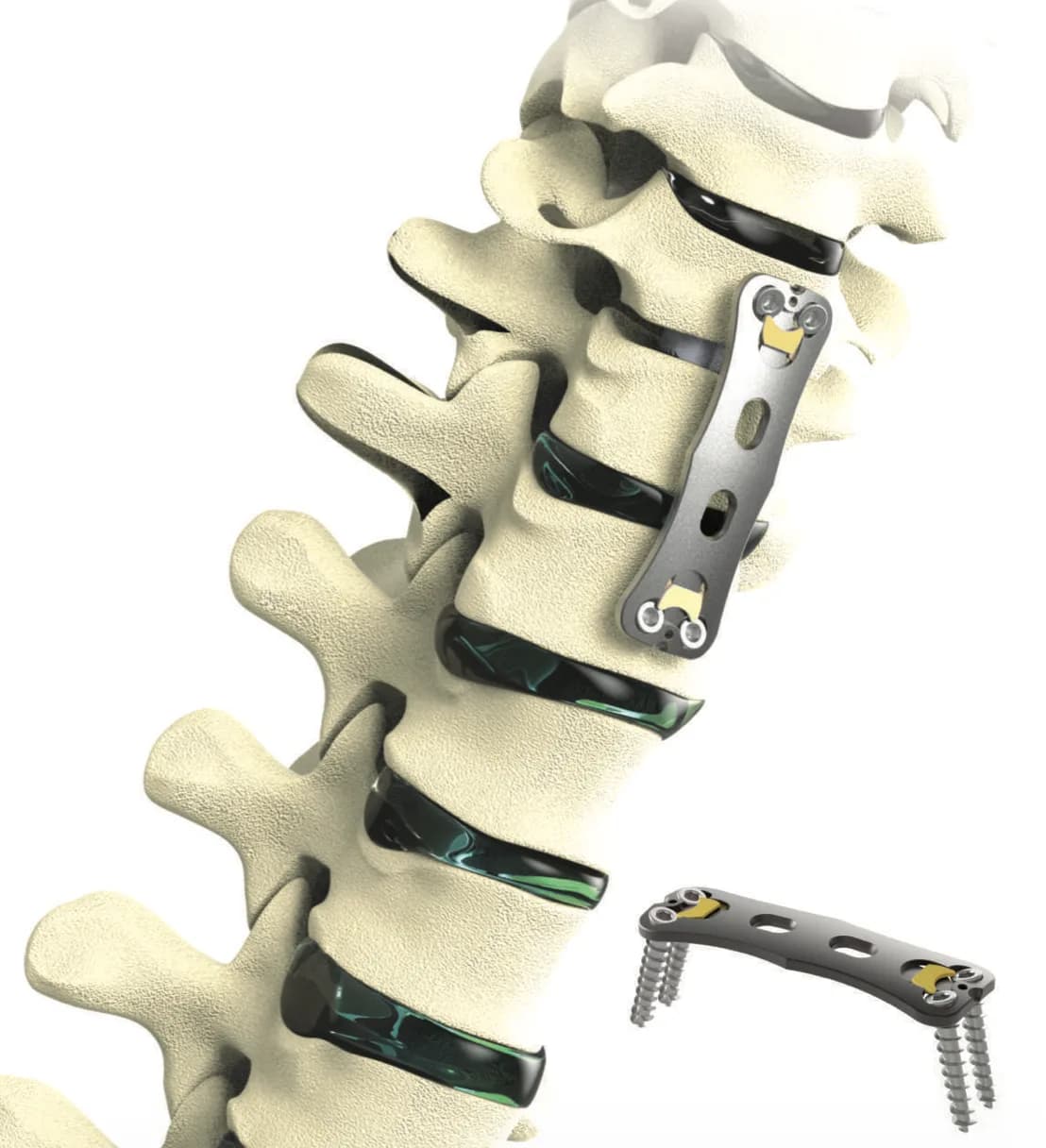 Asterius Anterior Cervical Plate System
