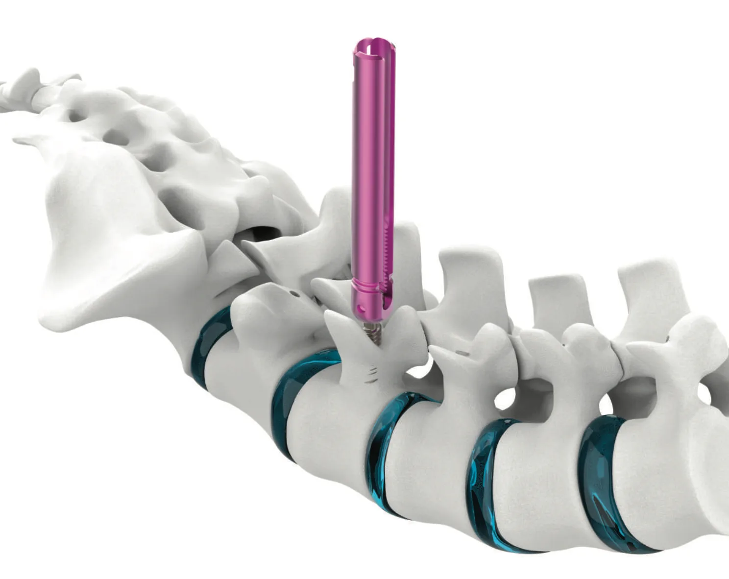 Vertaux MIS Screw System
