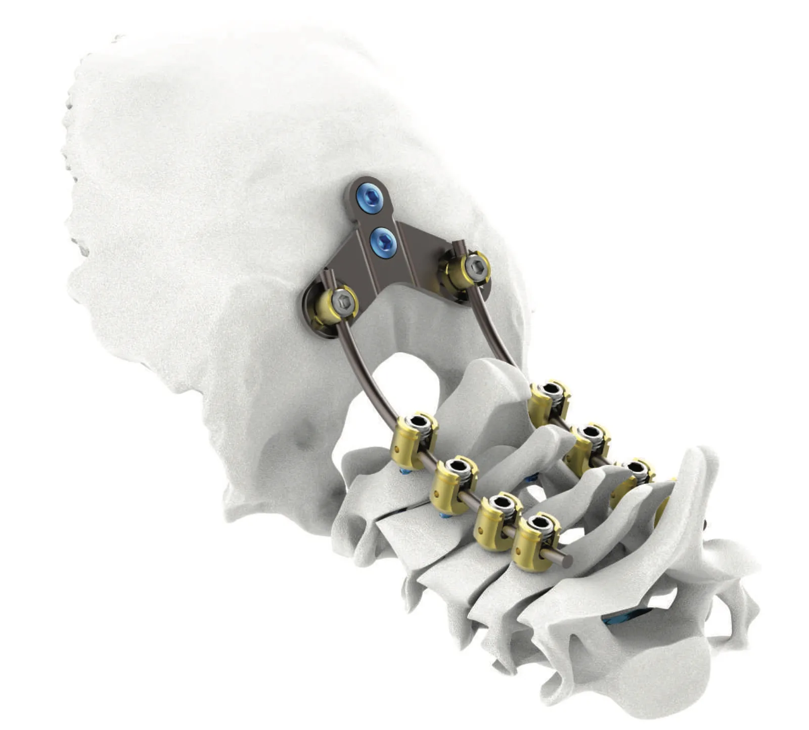 Vertaux Occipital System